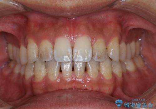 EMS エアフロー (エアフロープロフィラキシス マスター エアフローワン)の症例 治療前