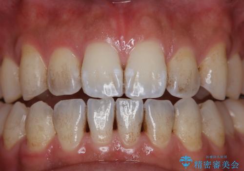 EMS エアフロー (エアフロープロフィラキシス マスター エアフローワン)の治療前