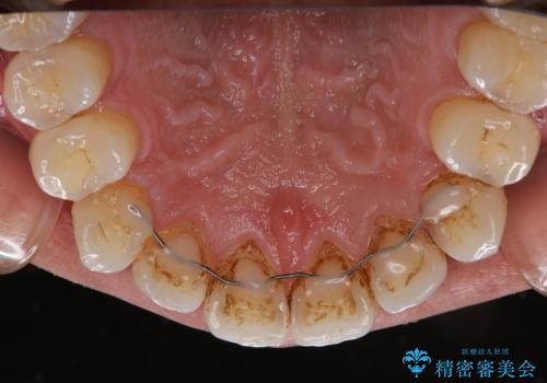 EMS エアフロー (エアフロープロフィラキシス マスター エアフローワン)の治療前