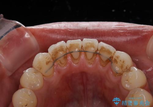 EMS エアフロー (エアフロープロフィラキシス マスター エアフローワン)の治療前