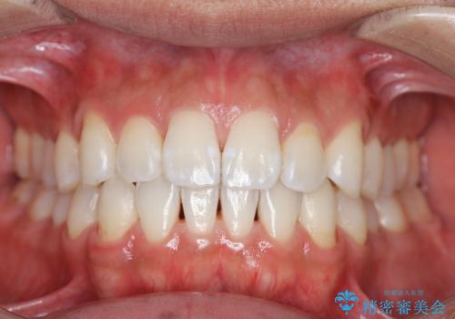 EMS エアフロー (エアフロープロフィラキシス マスター エアフローワン)の症例 治療後