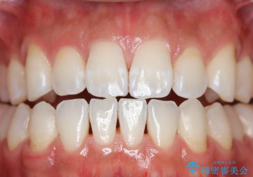 EMS エアフロー (エアフロープロフィラキシス マスター エアフローワン)の治療後