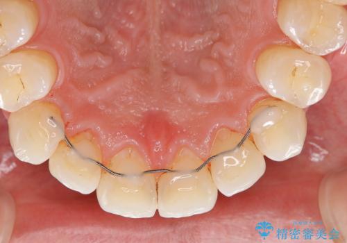 EMS エアフロー (エアフロープロフィラキシス マスター エアフローワン)の治療後