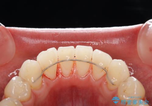 EMS エアフロー (エアフロープロフィラキシス マスター エアフローワン)の治療後