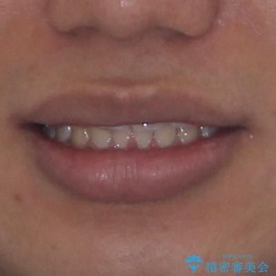 楽してデコボコを治したい ワイヤー矯正治療の治療後(顔貌)