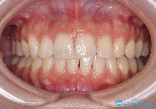 目立つ八重歯を改善 ワイヤー装置での抜歯矯正の症例 治療後