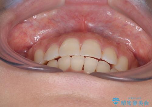 目立つ八重歯を改善 ワイヤー装置での抜歯矯正の治療後