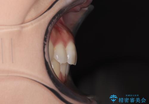 目立つ八重歯を改善 ワイヤー装置での抜歯矯正の治療後