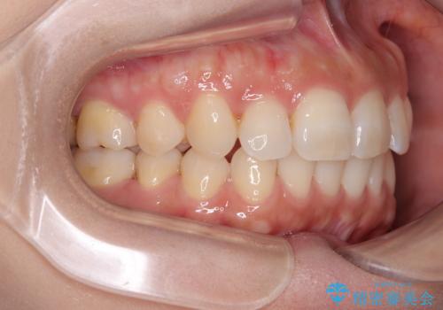 目立つ八重歯を改善 ワイヤー装置での抜歯矯正の治療後