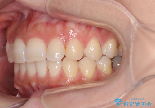 目立つ八重歯を改善 ワイヤー装置での抜歯矯正の治療後