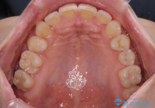 目立つ八重歯を改善　ワイヤー装置での抜歯矯正の治療後