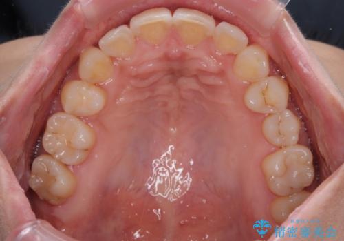 目立つ八重歯を改善 ワイヤー装置での抜歯矯正の治療後