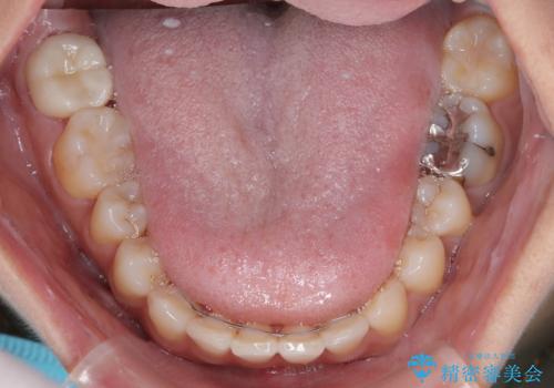 目立つ八重歯を改善 ワイヤー装置での抜歯矯正の治療後