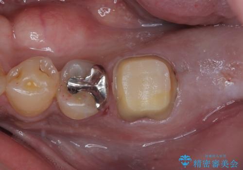 奥歯が痛い 破折した奥歯のインプラント治療の治療前