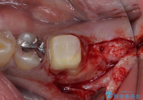 奥歯が痛い 破折した奥歯のインプラント治療の治療中