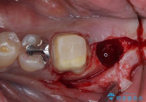 奥歯が痛い 破折した奥歯のインプラント治療の治療後