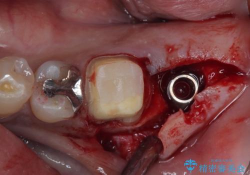 奥歯が痛い 破折した奥歯のインプラント治療の治療前