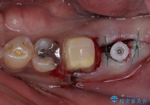 奥歯が痛い 破折した奥歯のインプラント治療の治療中