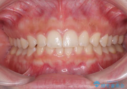 ディープバイトを短期間で改善 ワイヤー矯正治療の症例 治療後