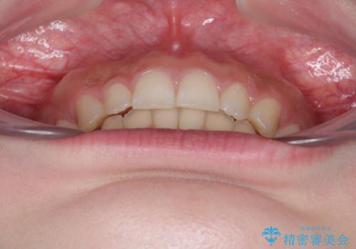 ディープバイトを短期間で改善 ワイヤー矯正治療の治療後