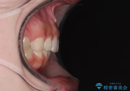 ディープバイトを短期間で改善 ワイヤー矯正治療の治療後