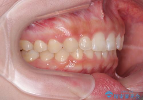 ディープバイトを短期間で改善 ワイヤー矯正治療の治療後