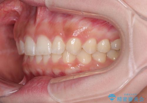 ディープバイトを短期間で改善 ワイヤー矯正治療の治療後