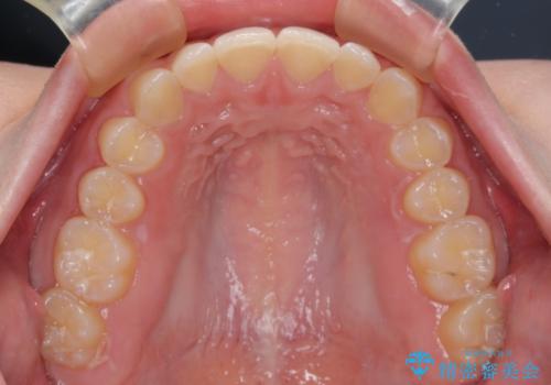 ディープバイトを短期間で改善 ワイヤー矯正治療の治療後