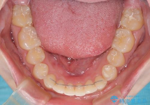 ディープバイトを短期間で改善　ワイヤー矯正治療の治療後