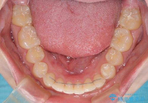 ディープバイトを短期間で改善 ワイヤー矯正治療の治療後