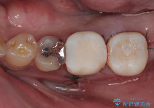 奥歯が痛い 破折した奥歯のインプラント治療の治療中
