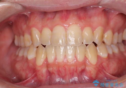 オープンバイトをインビザラインで矯正治療の治療後