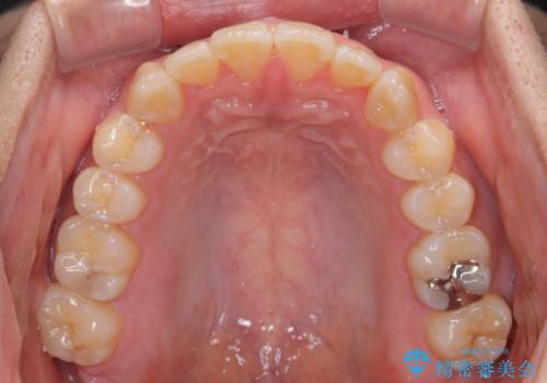 オープンバイトをインビザラインで矯正治療の治療後