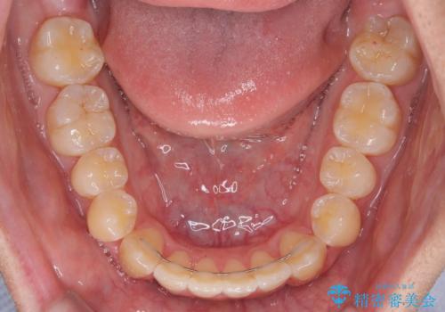 オープンバイトをインビザラインで矯正治療の治療後