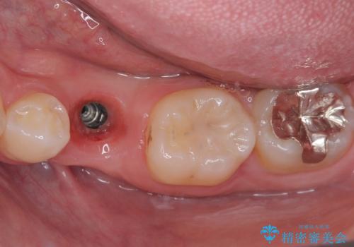 永久歯の先天欠如 インプラントによる補綴の治療後