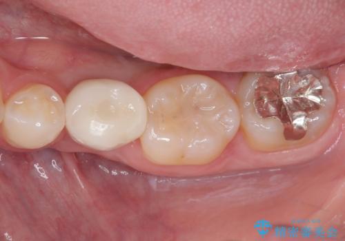 永久歯の先天欠如 インプラントによる補綴の症例 治療後