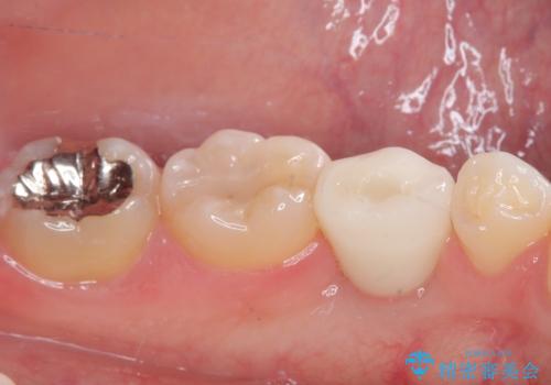 永久歯の先天欠如 インプラントによる補綴の治療後