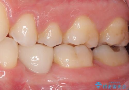 永久歯の先天欠如 インプラントによる補綴の治療後