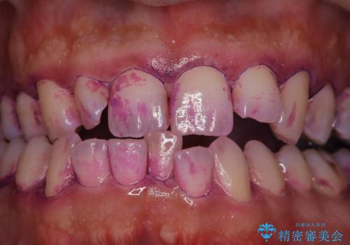 妻に歯医者へ行くよう言われて来院の症例 治療前