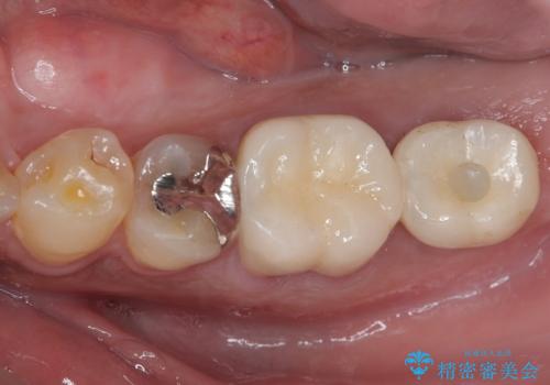 奥歯が痛い　破折した奥歯のインプラント治療の治療後