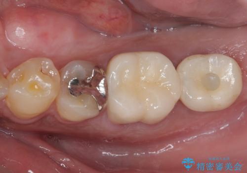 奥歯が痛い 破折した奥歯のインプラント治療の症例 治療後
