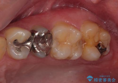 銀歯が何度も外れる オールセラミッククラウンの症例 治療前