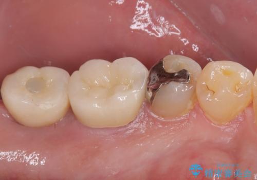 奥歯が痛い 破折した奥歯のインプラント治療の治療後