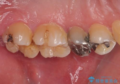 銀歯が何度も外れる オールセラミッククラウンの治療前