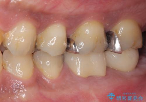 奥歯が痛い　破折した奥歯のインプラント治療の治療後