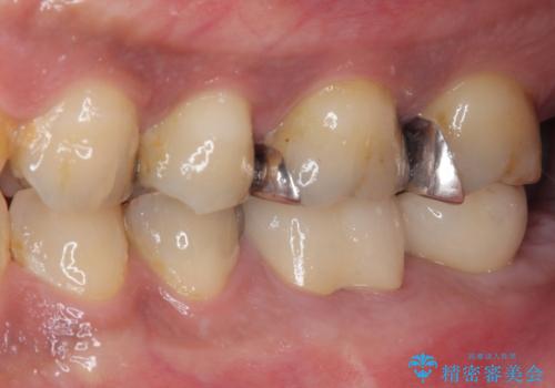 奥歯が痛い 破折した奥歯のインプラント治療の治療後
