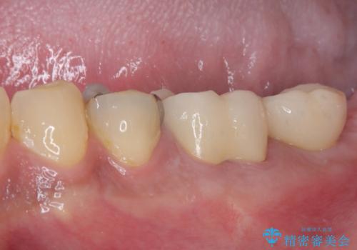奥歯が痛い 破折した奥歯のインプラント治療の治療後