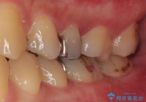 銀歯が何度も外れる オールセラミッククラウンの治療前