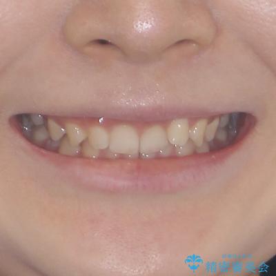 ディープバイトを短期間で改善 ワイヤー矯正治療の治療前(顔貌)