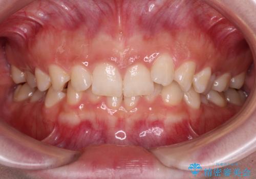 ディープバイトを短期間で改善 ワイヤー矯正治療の症例 治療前